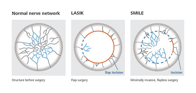 Chart Illustrating the Normal Nerve Network, LASIK Surgery and SMILE Surgery